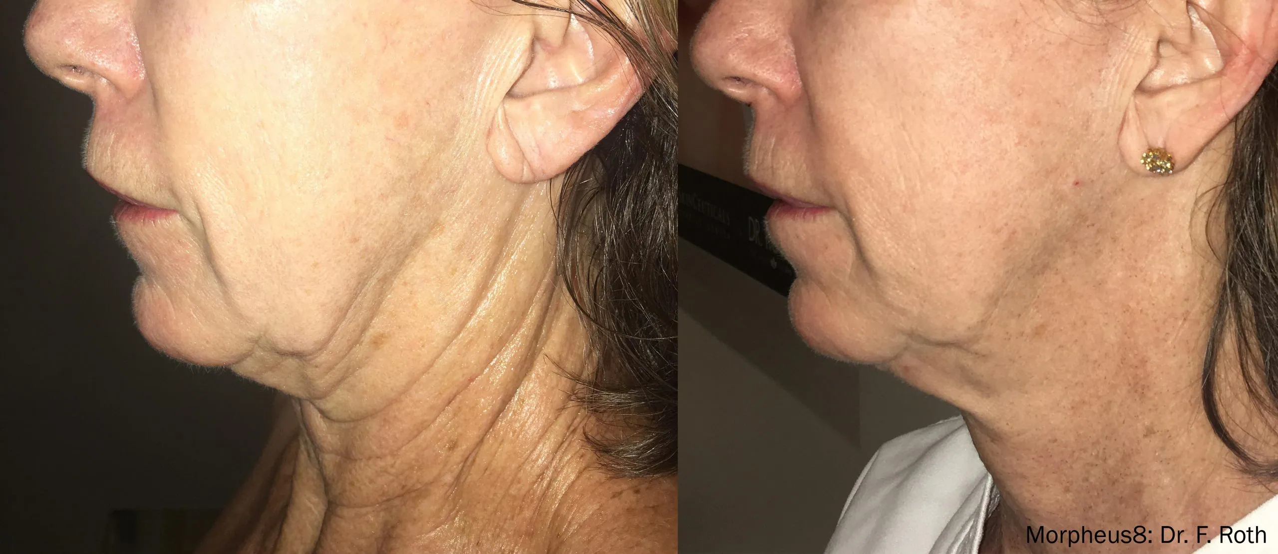 Morpheus8 RF Microneedling before and after