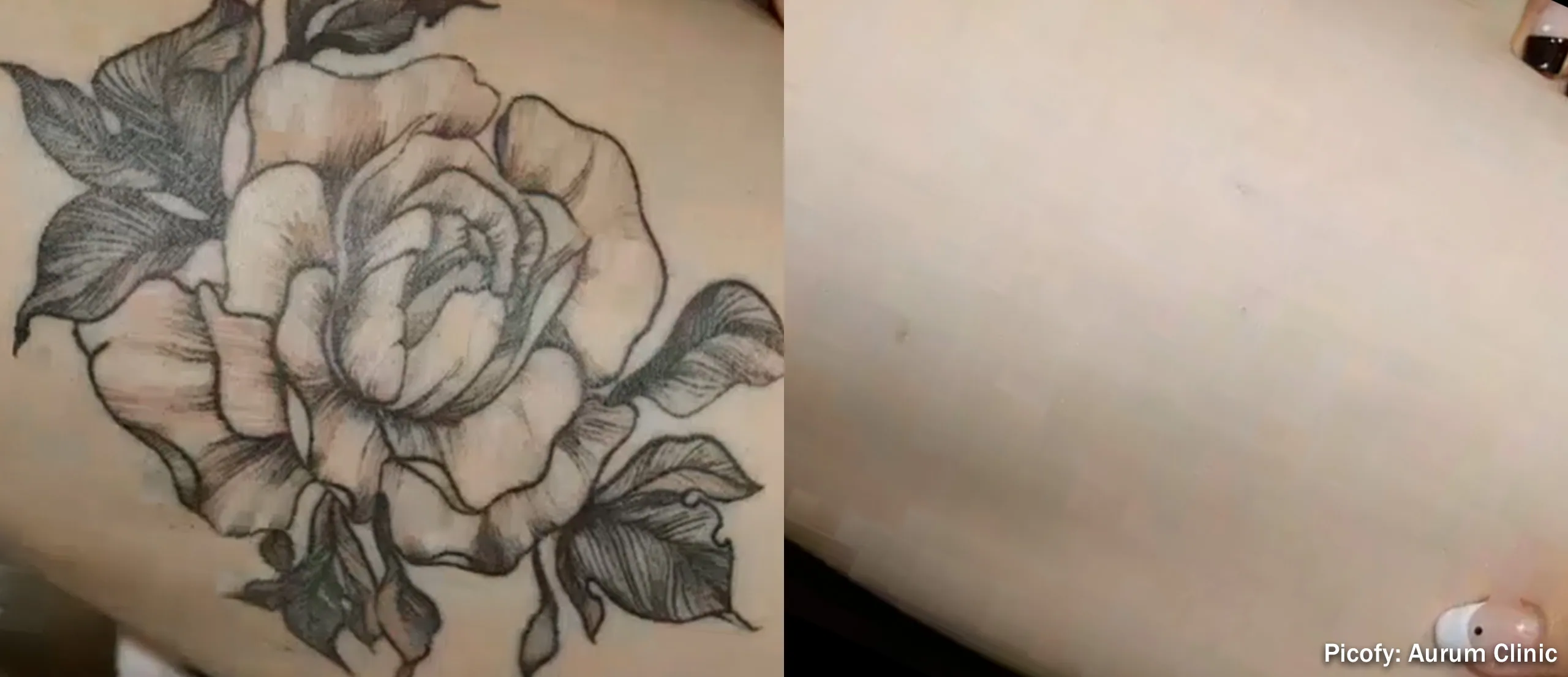 Picofy Laser before and after