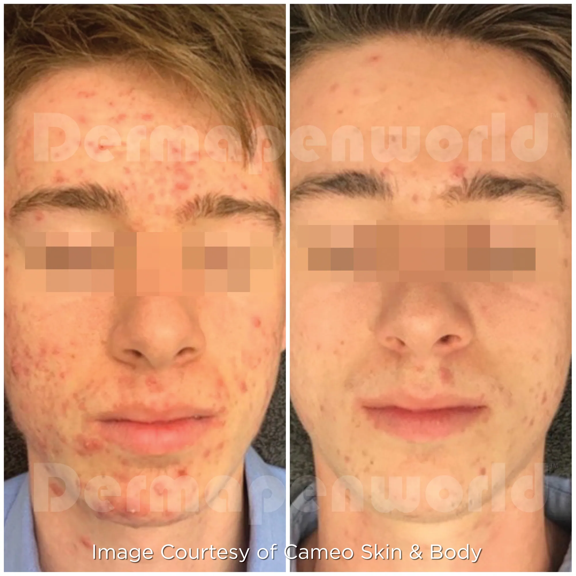 Dermapen 4 Microneedling before and after
