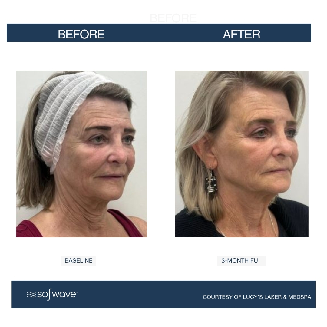 Sofwave before and after