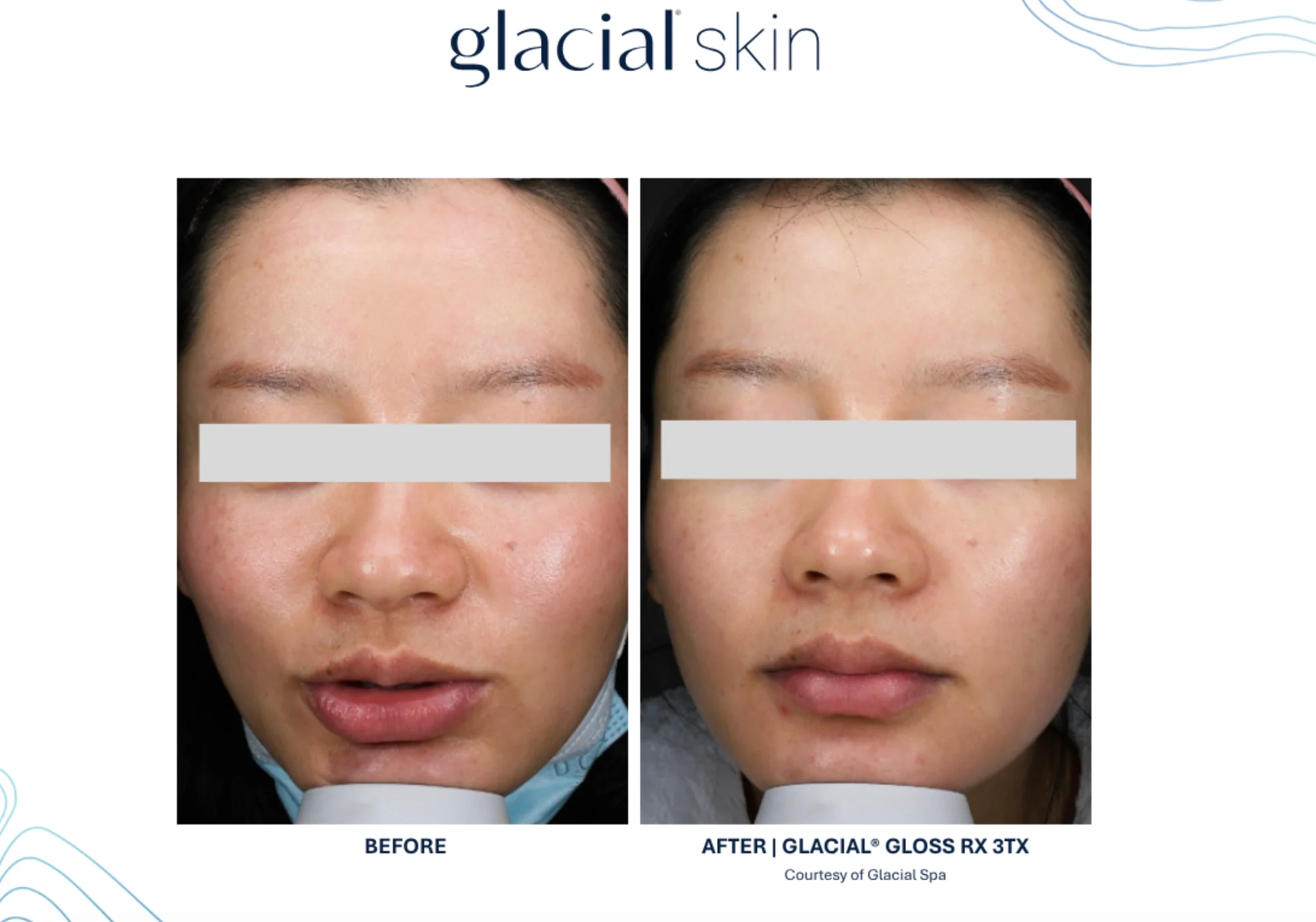 Glacial Skin™ before and after