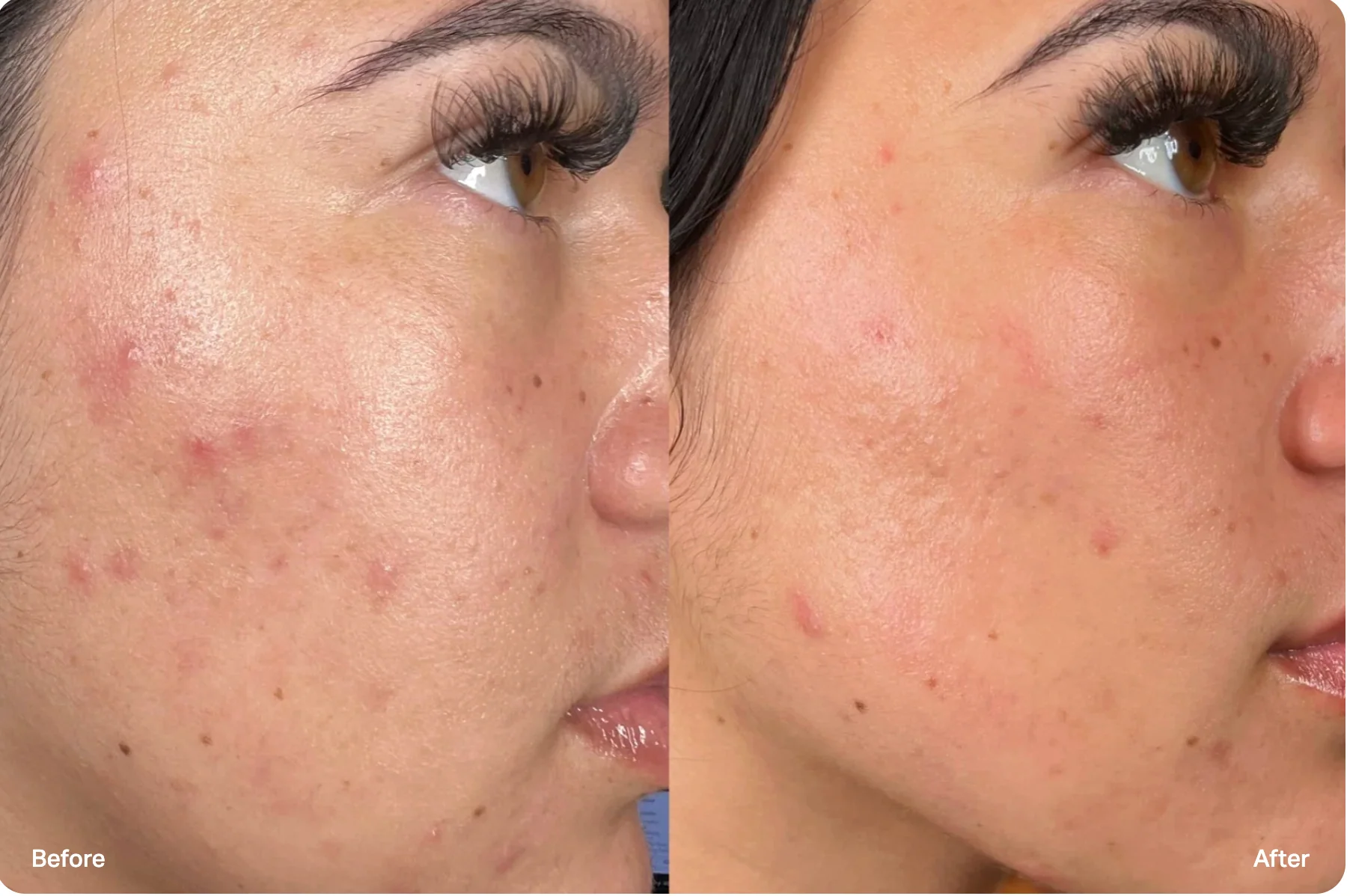 Hydro+ with LED before and after