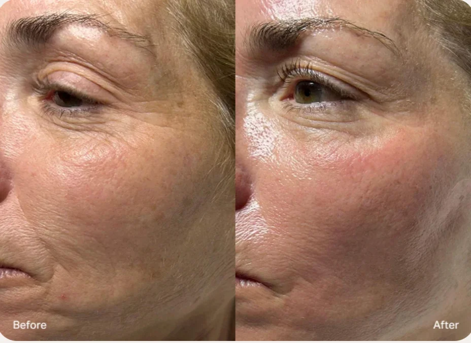 HydraFacial® Signature before and after