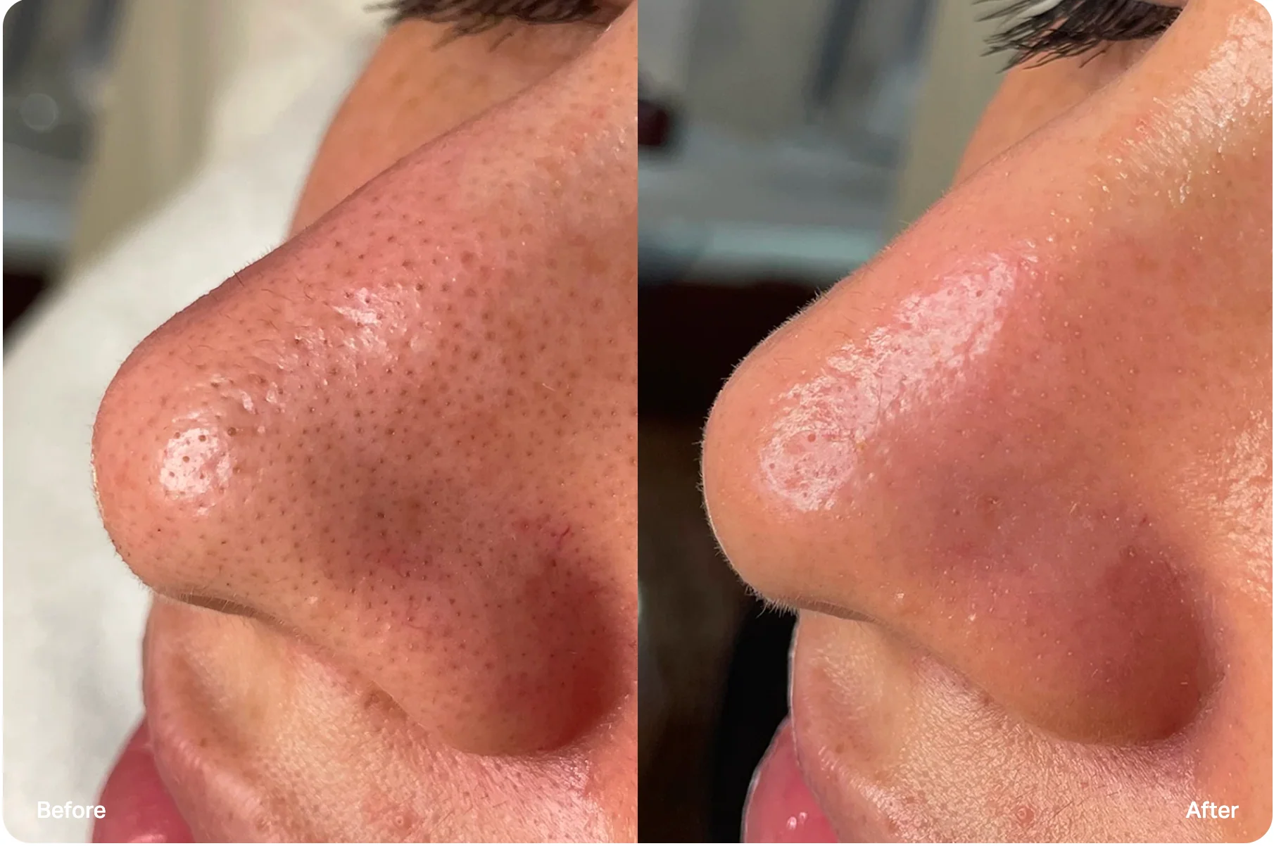 HydraGlow Facial before and after