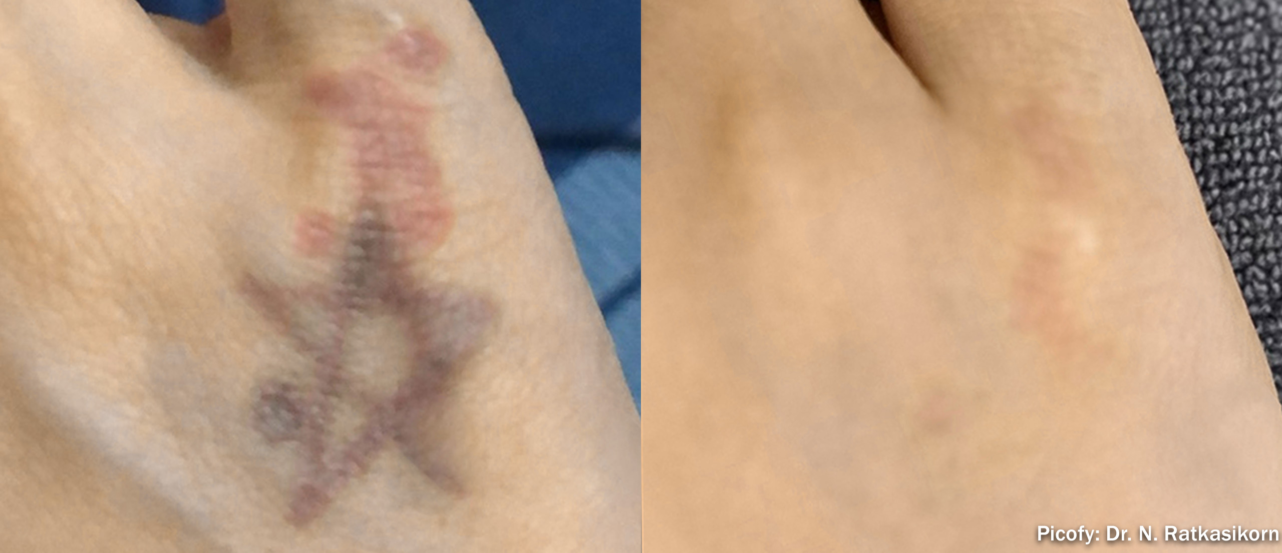 Laser Tattoo Removal before and after