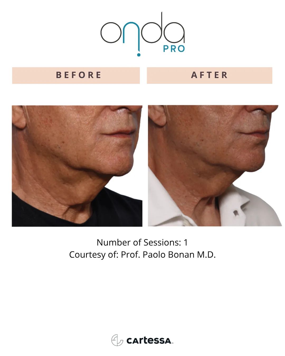 ONDA PRO before and after